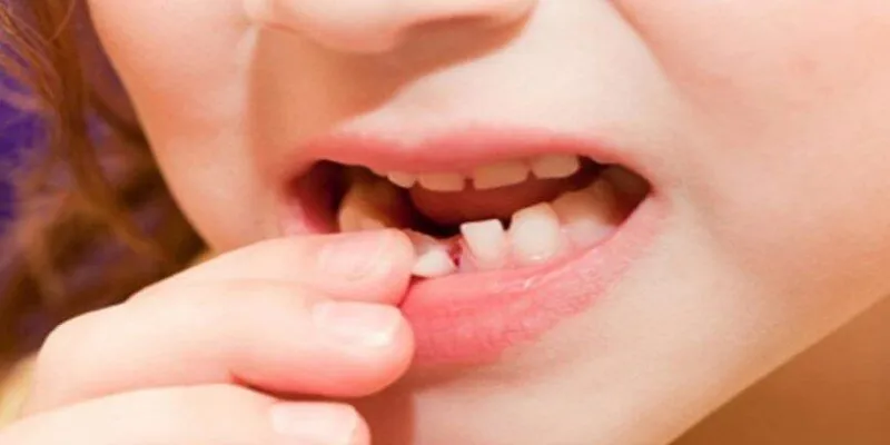 Chiêm bao thấy răng rụng và con số gợi ý cho bạn