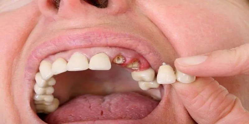 Giải mã thông điệp giấc mơ thấy rụng răng